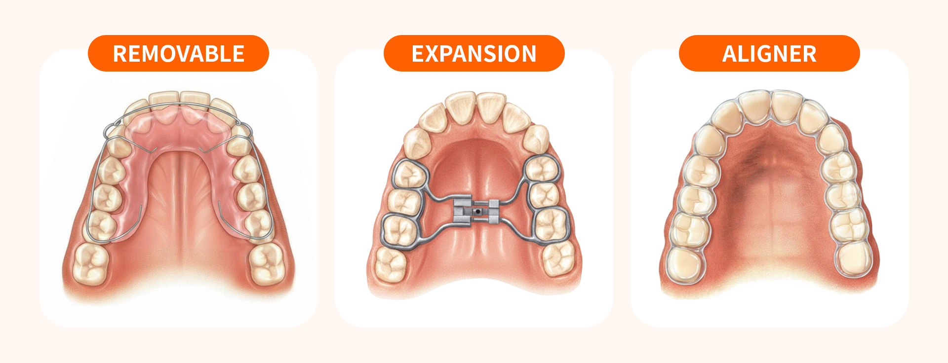 대표적인 비수술 교정 사례 3가지를 나타낸 의학적 일러스트