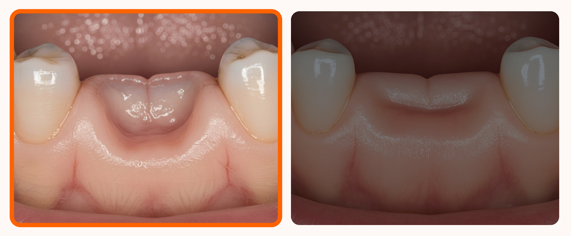 An image contrasting a normal jawbone with a severely lost jawbone