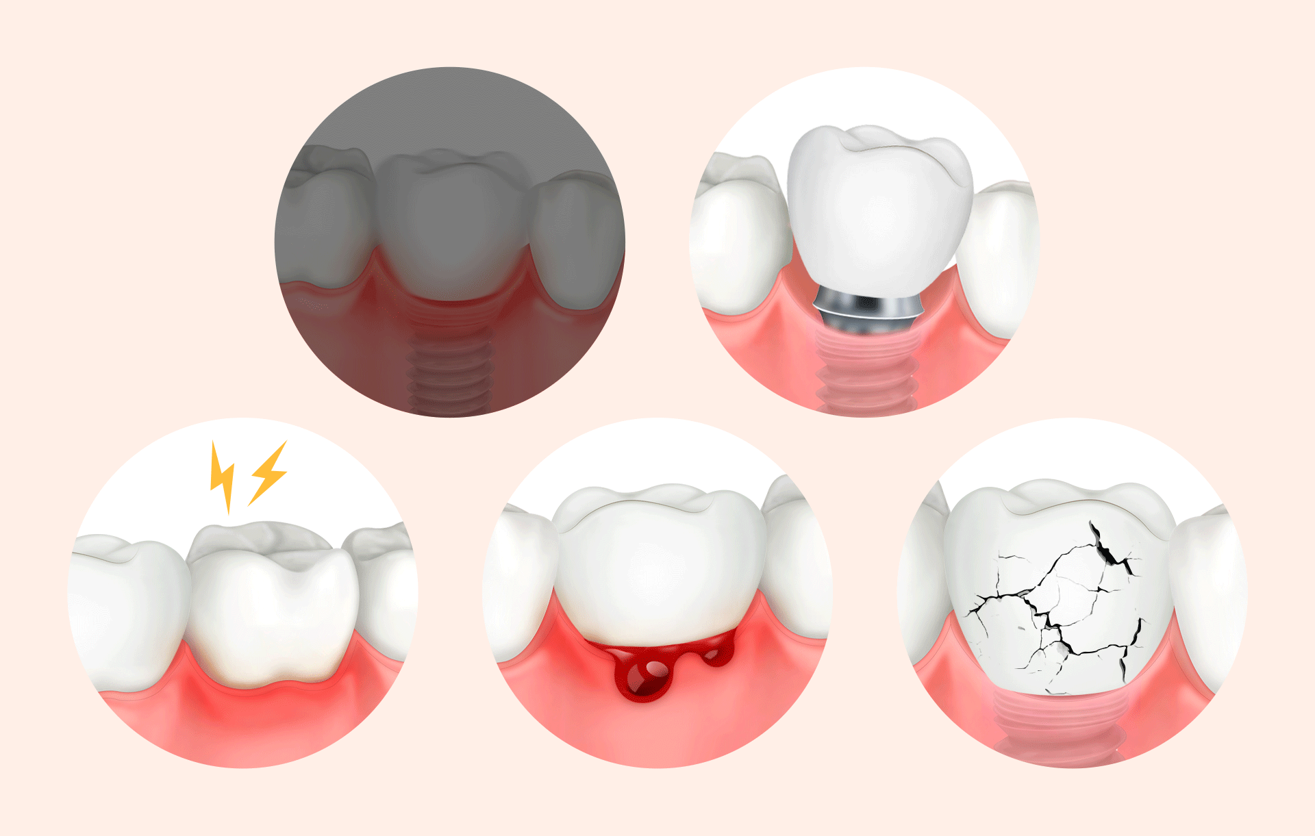 An image showing signs that dental implant re-implantation is necessary