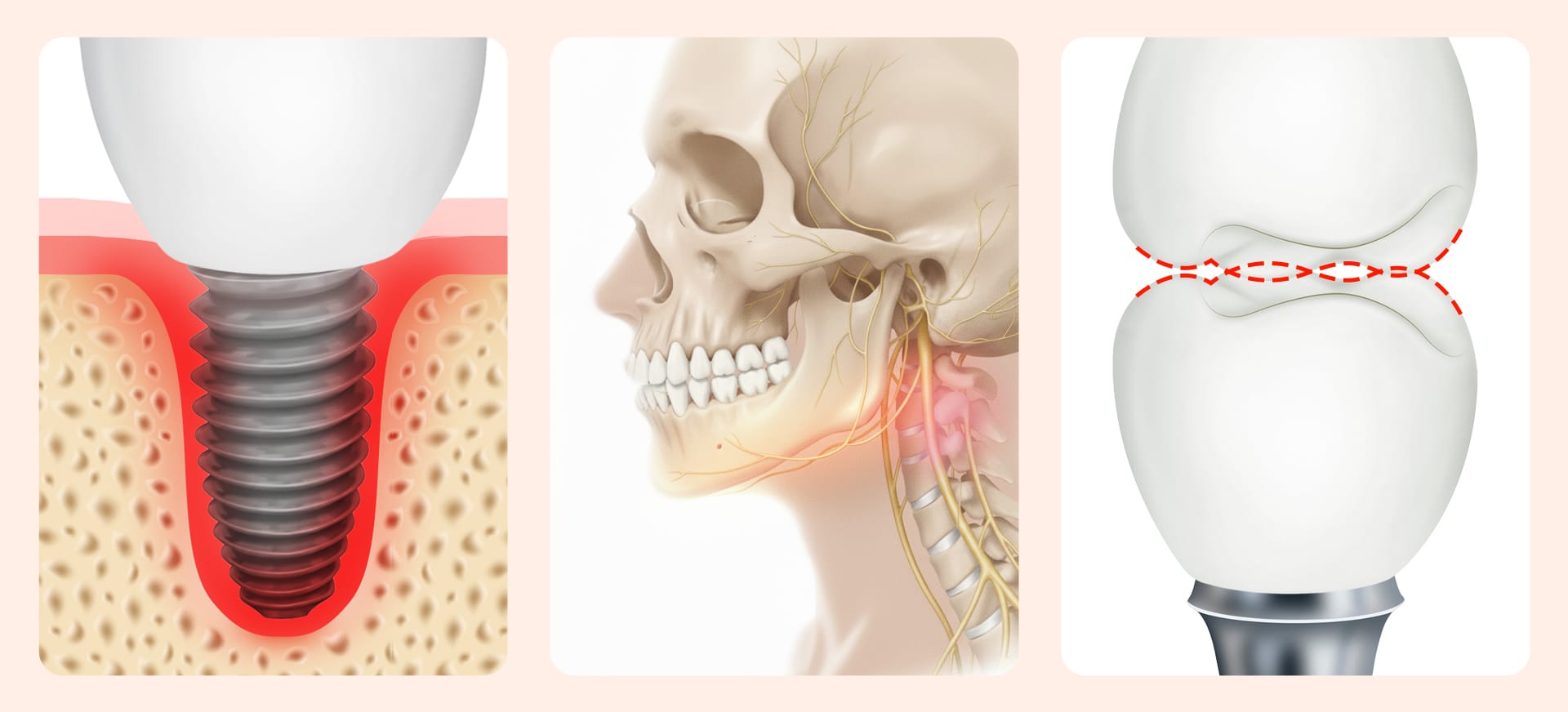An image illustrating the cause of implant re-implantation: problems arising from a lack of proficiency (by the surgeon)