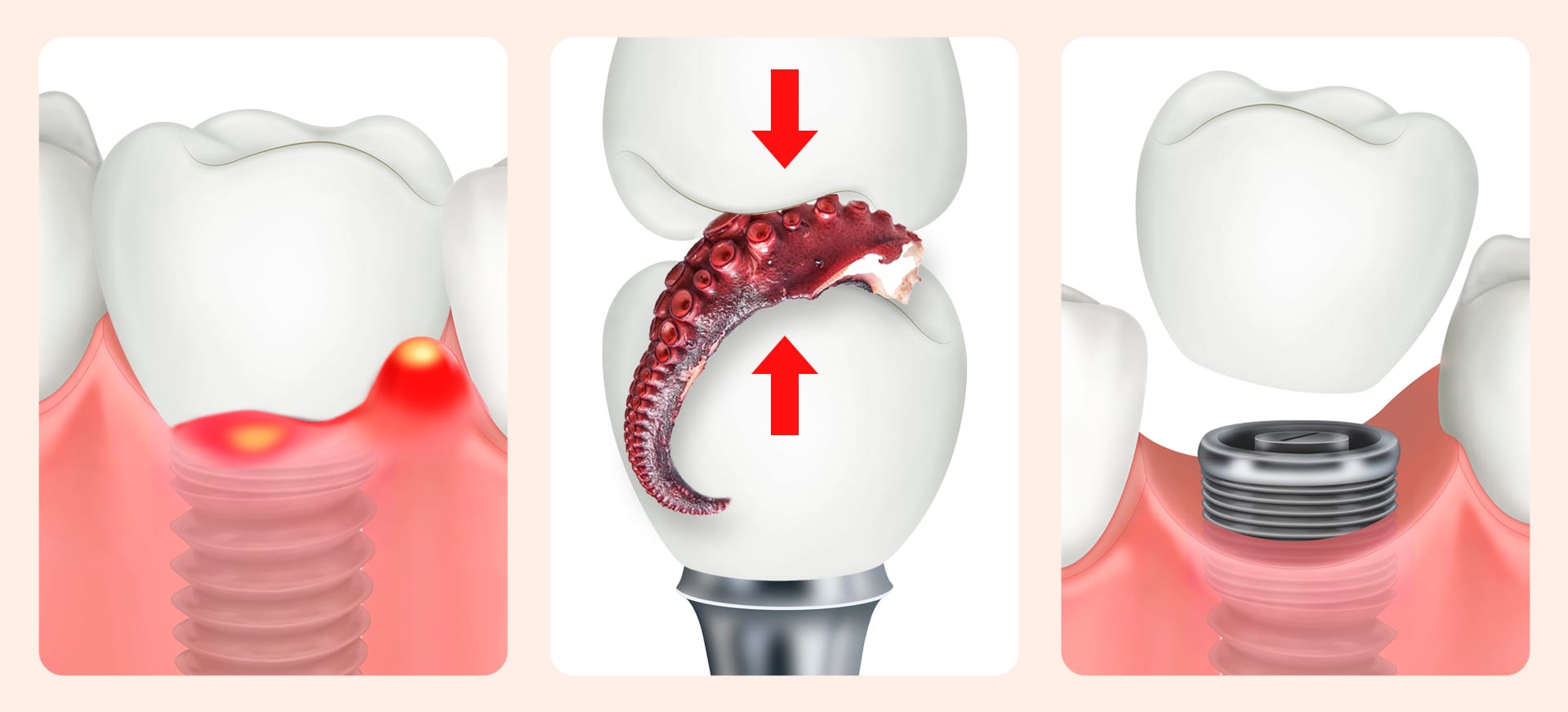 An image illustrating the cause of implant re-implantation: negligence in maintenance and lifestyle habits