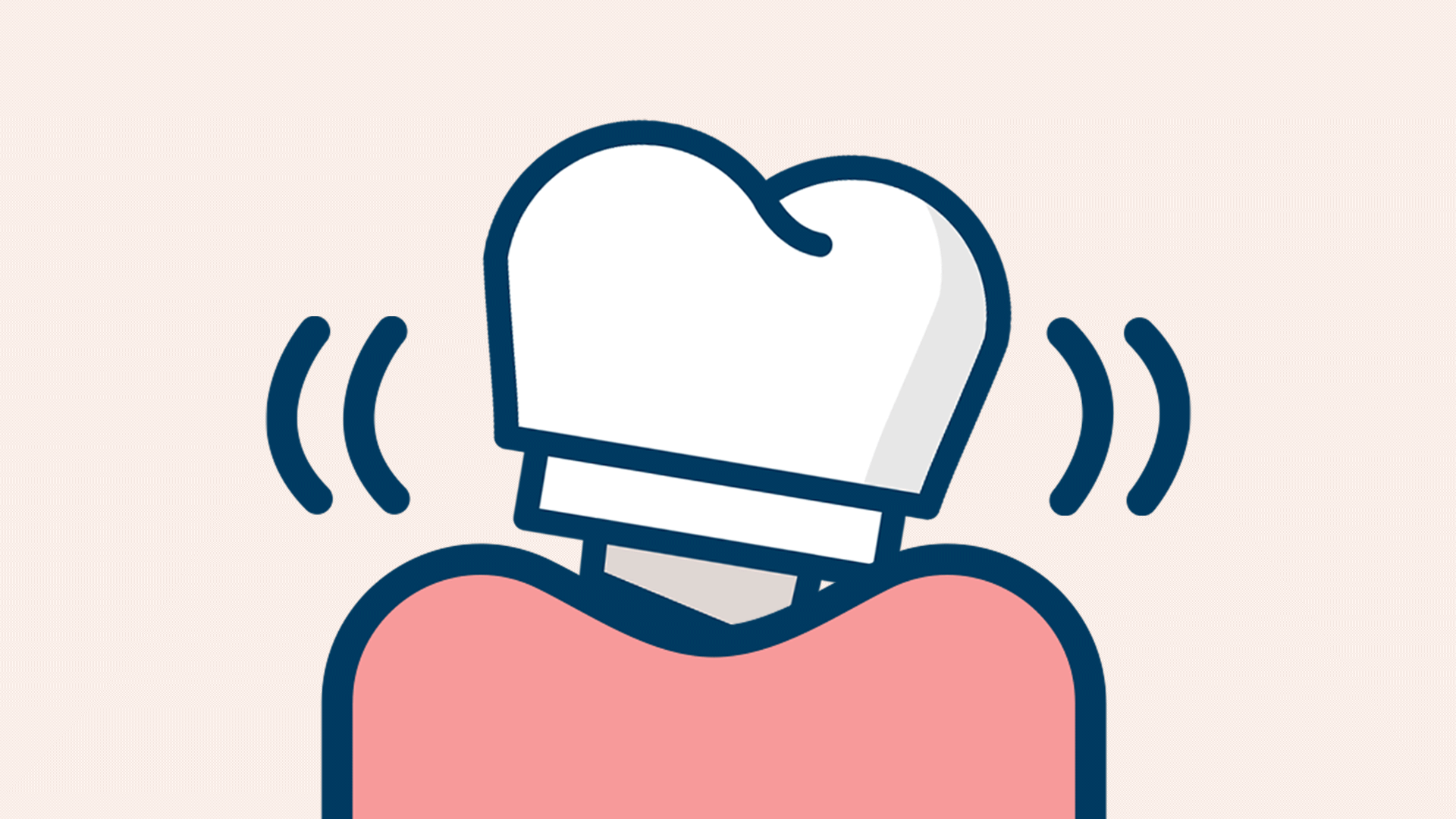 임플란트가 흔들리거나 빠질 것 같은 경우