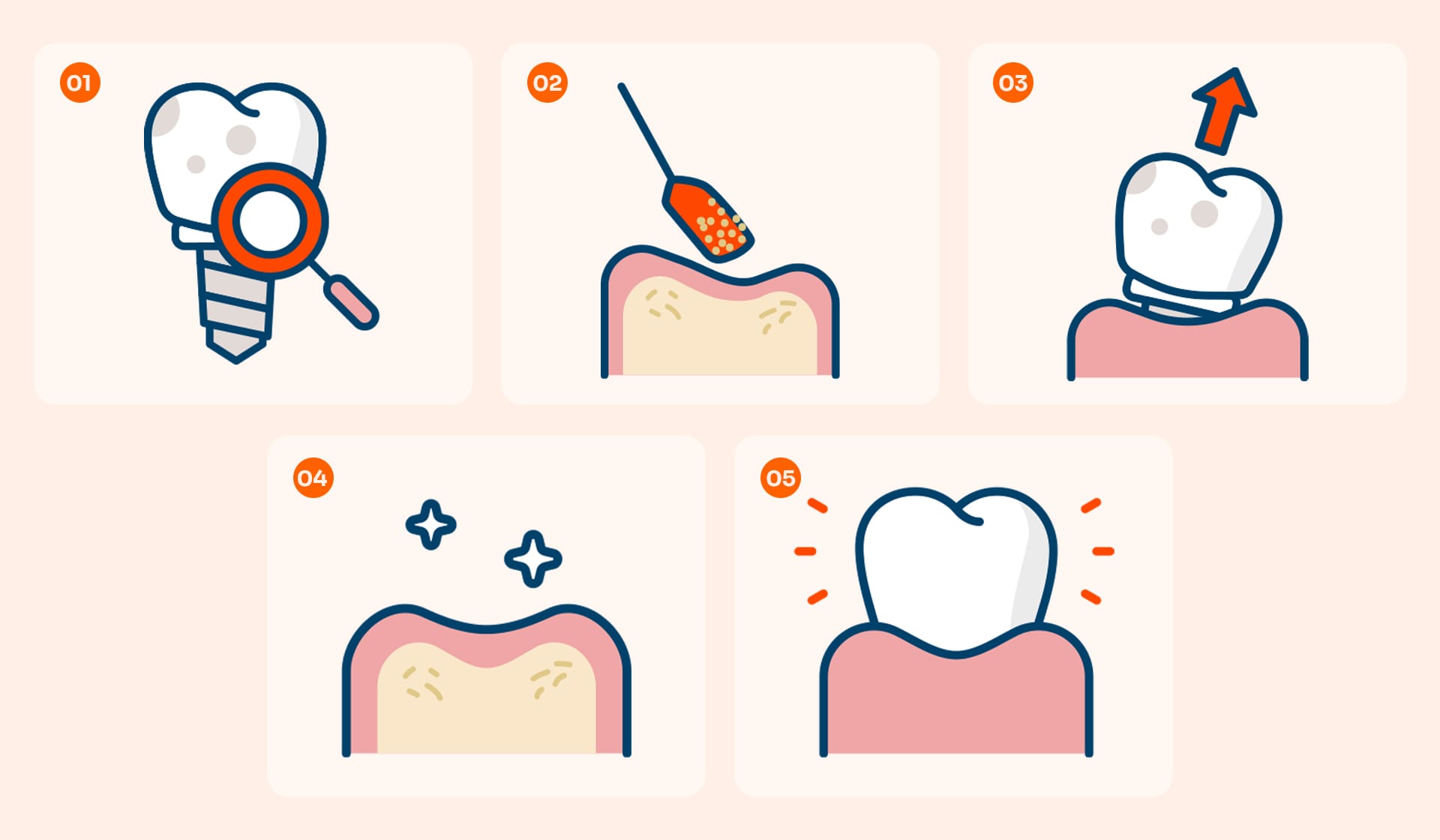임플란트 재수술의 5단계 과정: 정밀 진단, 기존 임플란트 제거, 뼈이식, 회복 기간, 새로운 임플란트 식립 및 보철물 장착