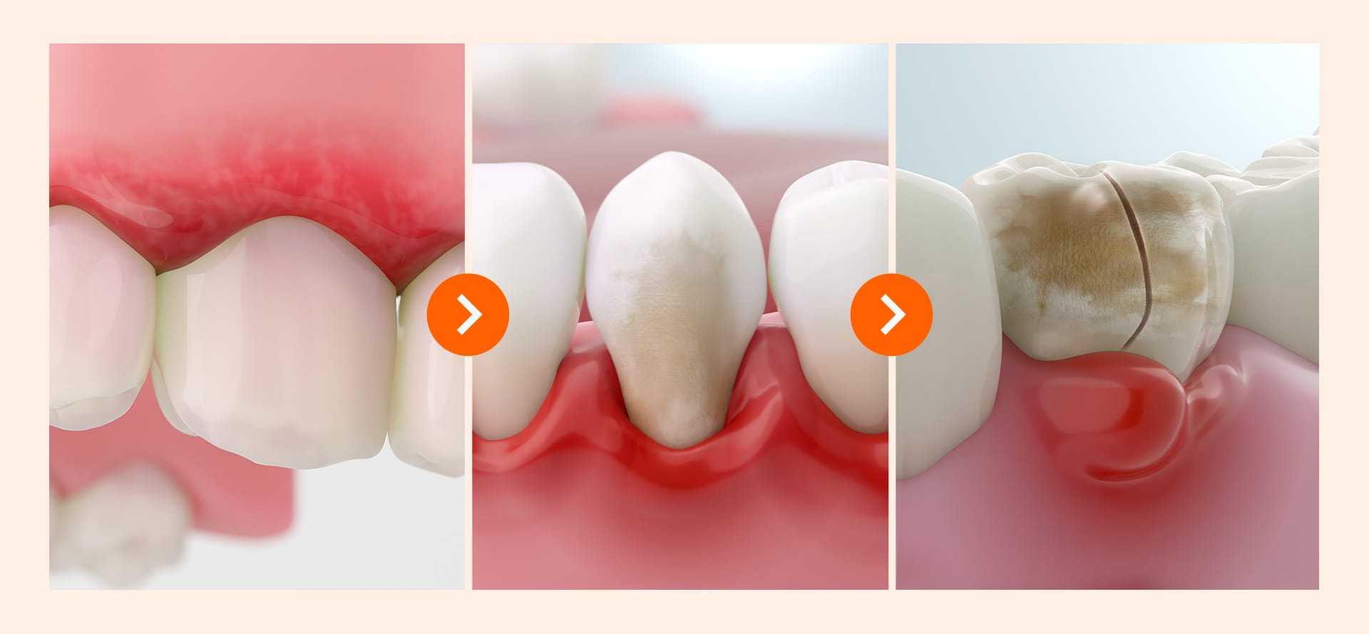 An image showing the damage stages of an implant (early, moderate, severe/late)