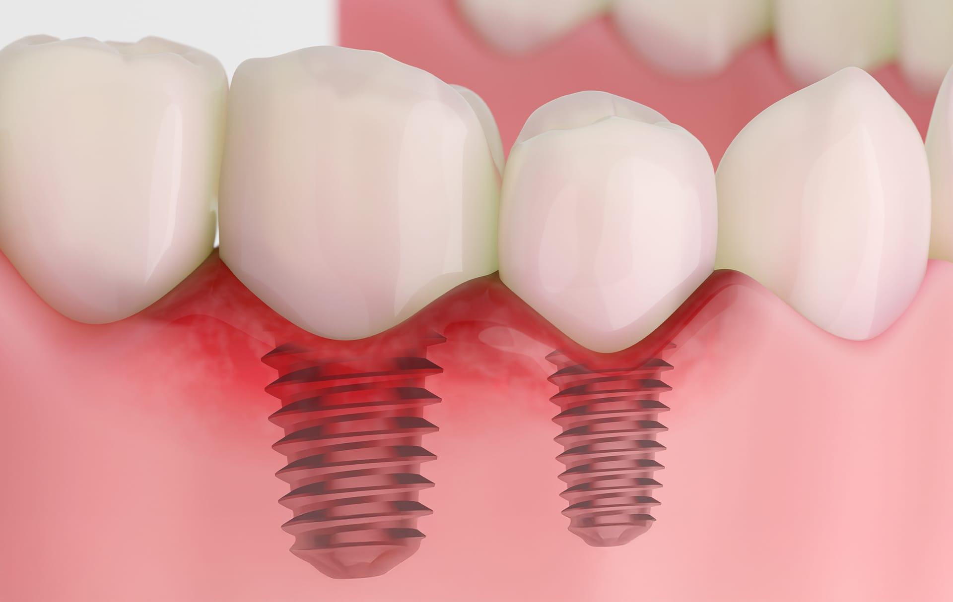 The appearance of early-stage implant damage