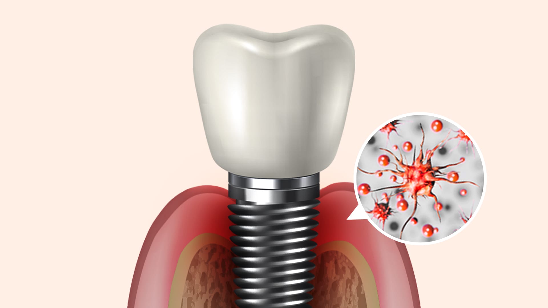 The appearance of moderate-stage implant damage, showing peri-implantitis and bone loss