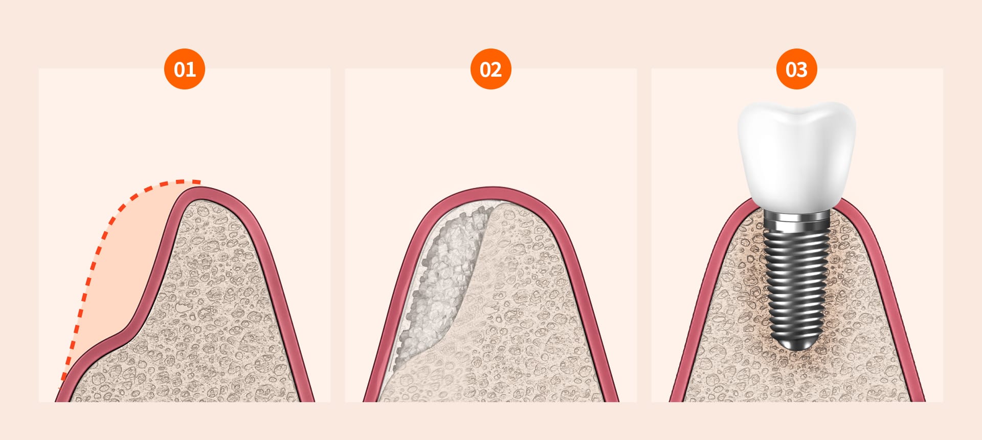 An infographic showing the steps of bone graft supplementation (bone augmentation)