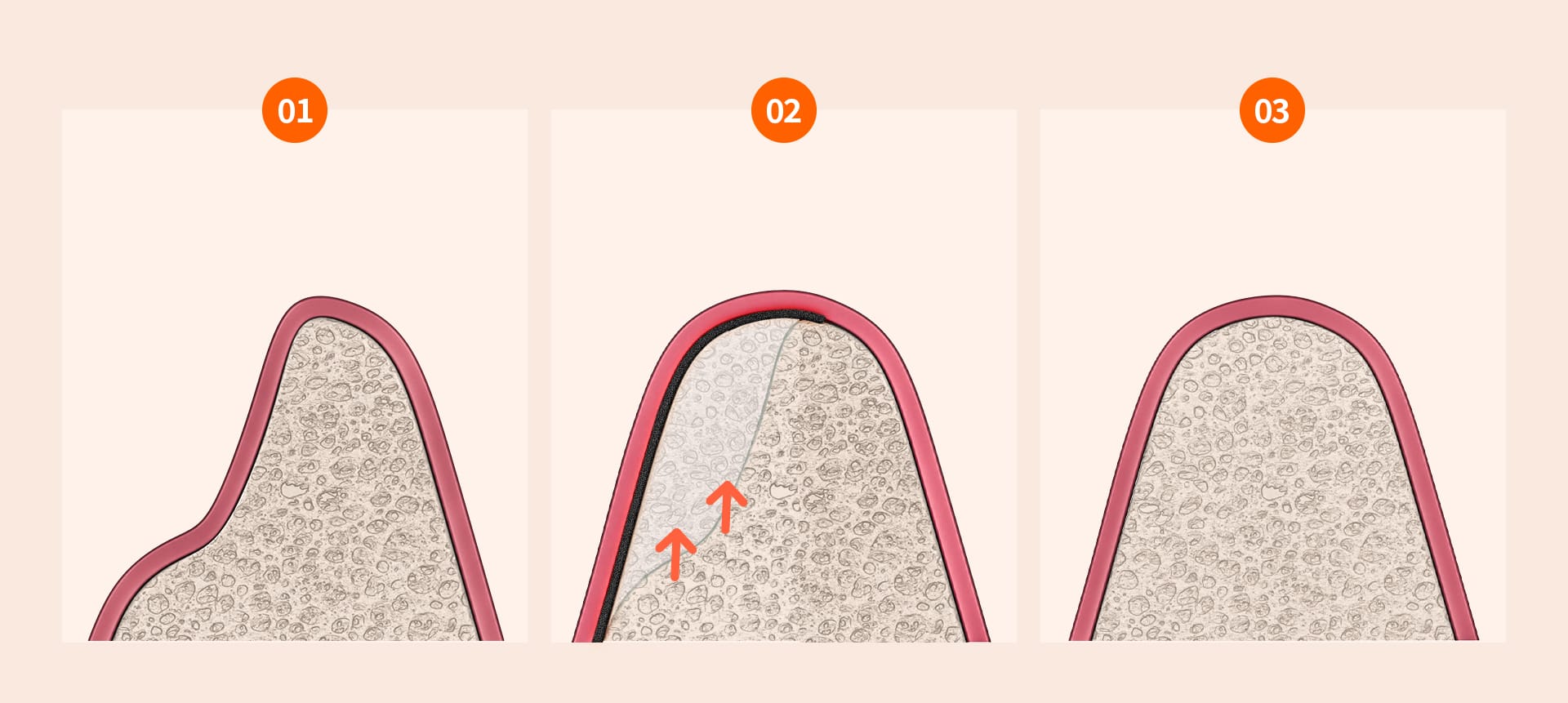 An infographic showing the steps of a bone membrane procedure (Guided Bone Regeneration/GBR)