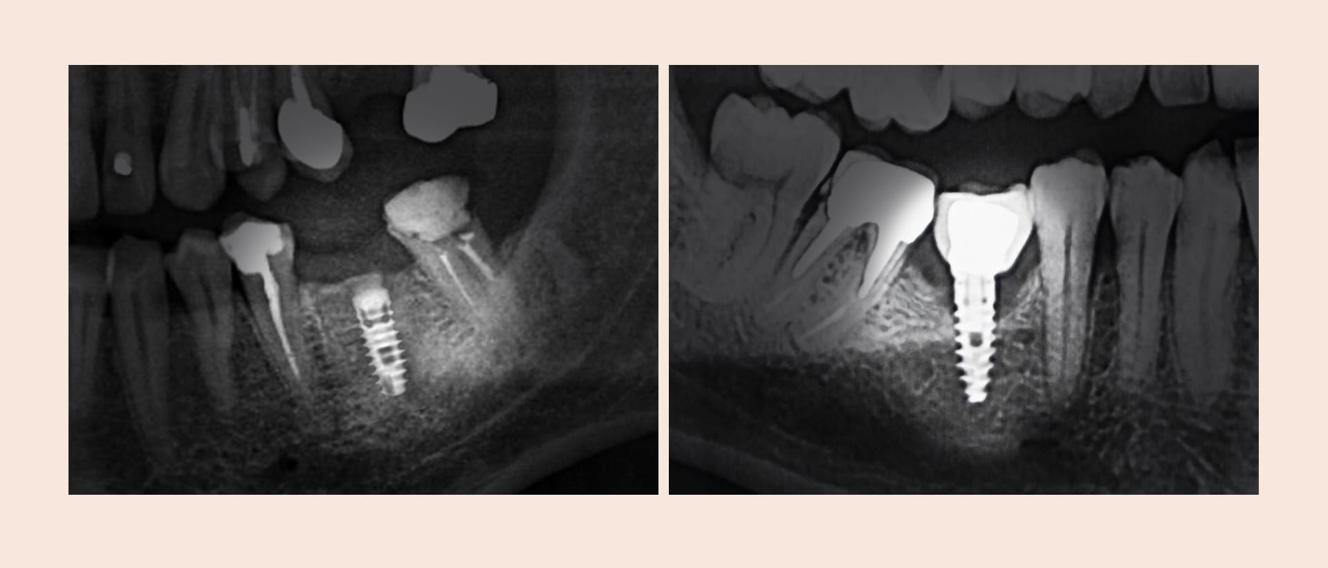 A scene showing severe bone loss and fixture fracture due to late-stage implant damage