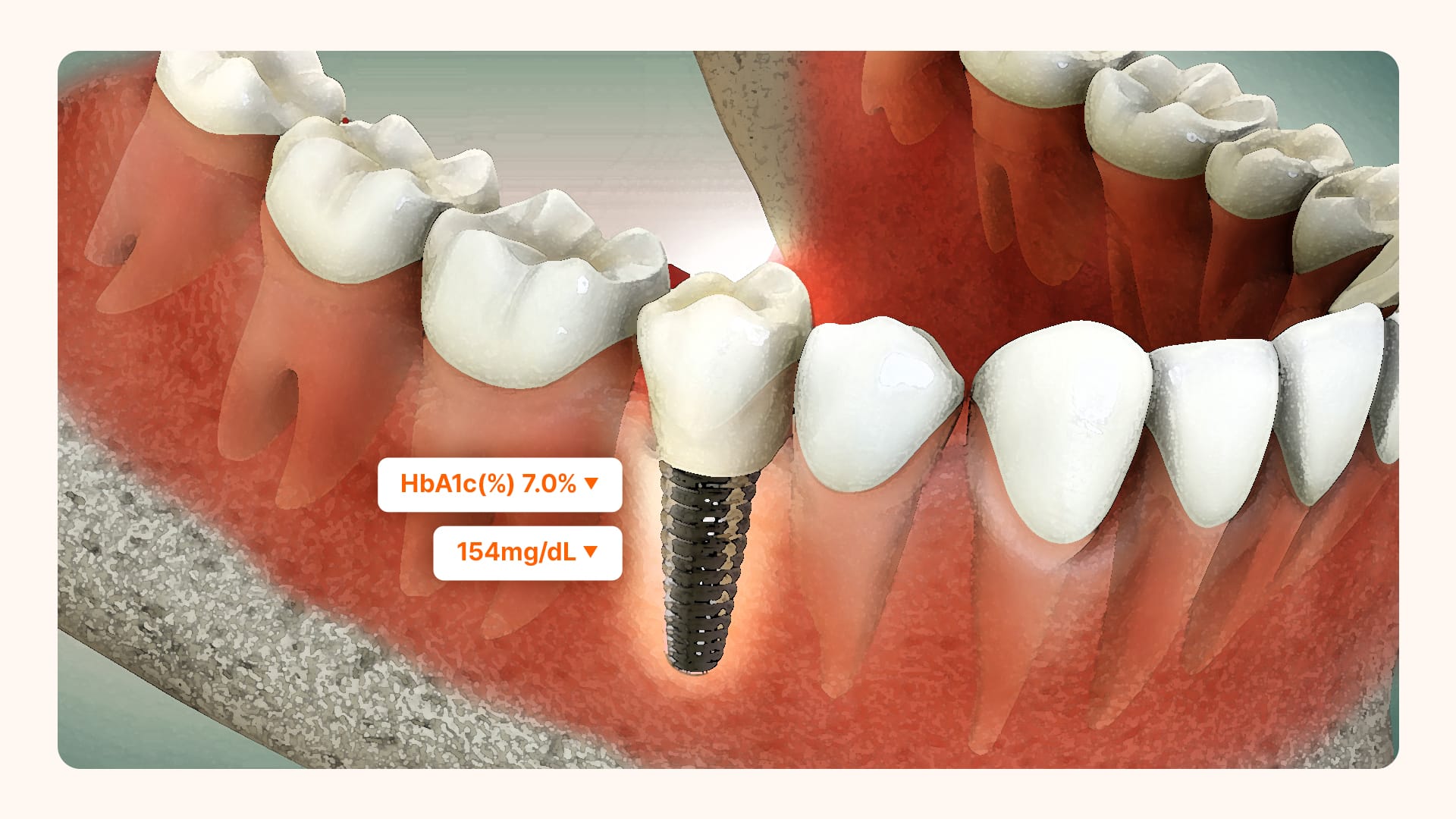 An image illustrating a successfully maintained dental implant due to well-managed blood sugar levels