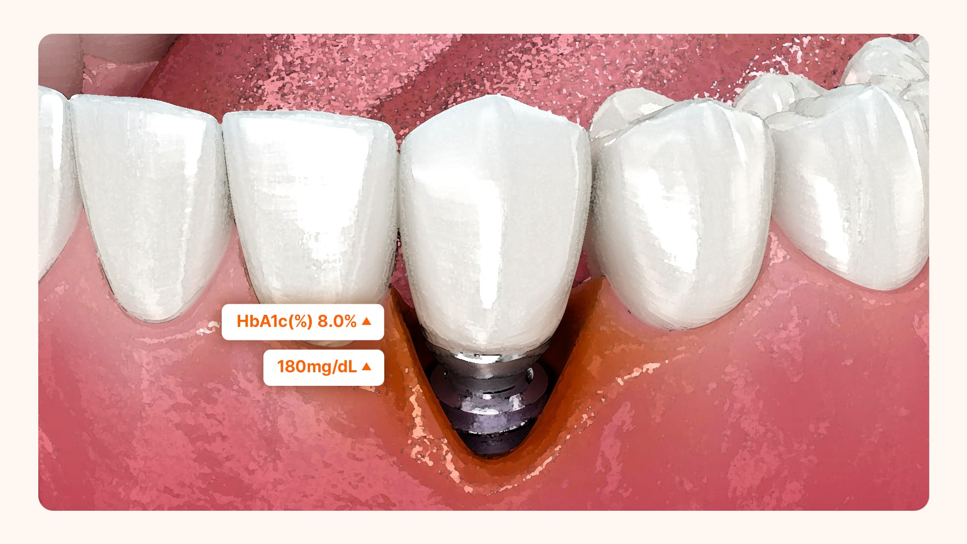 An image depicting the onset of alveolar bone loss around an implanted tooth