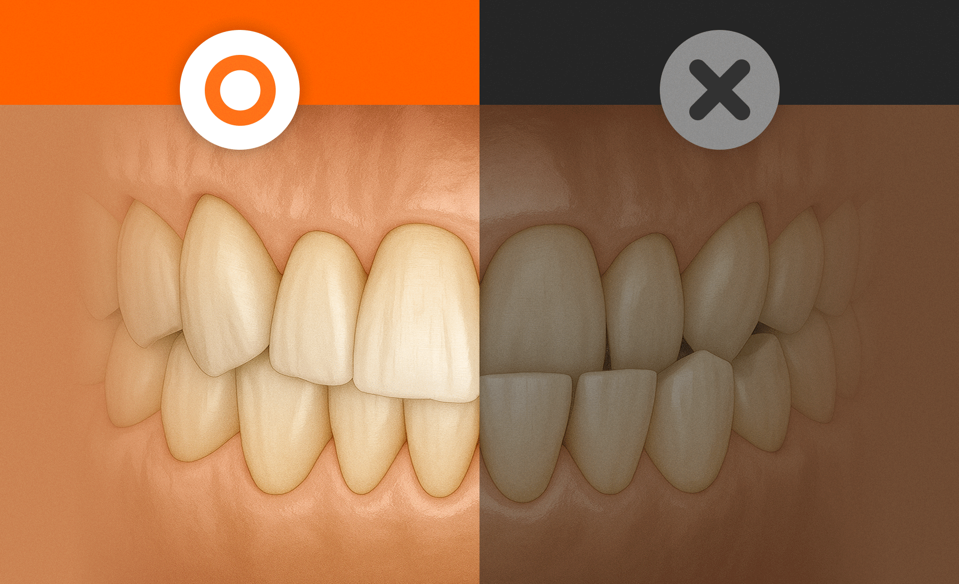 정상적인 치아와 아랫니가 나와 윗니를 덮는 반대교합의 비교 