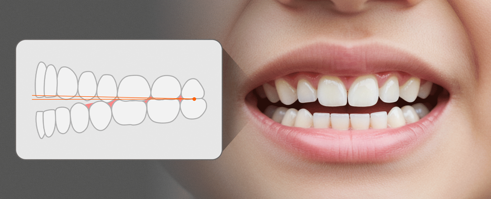 앞니가 닿지 않은 개방교합의 구강구조와 입모양