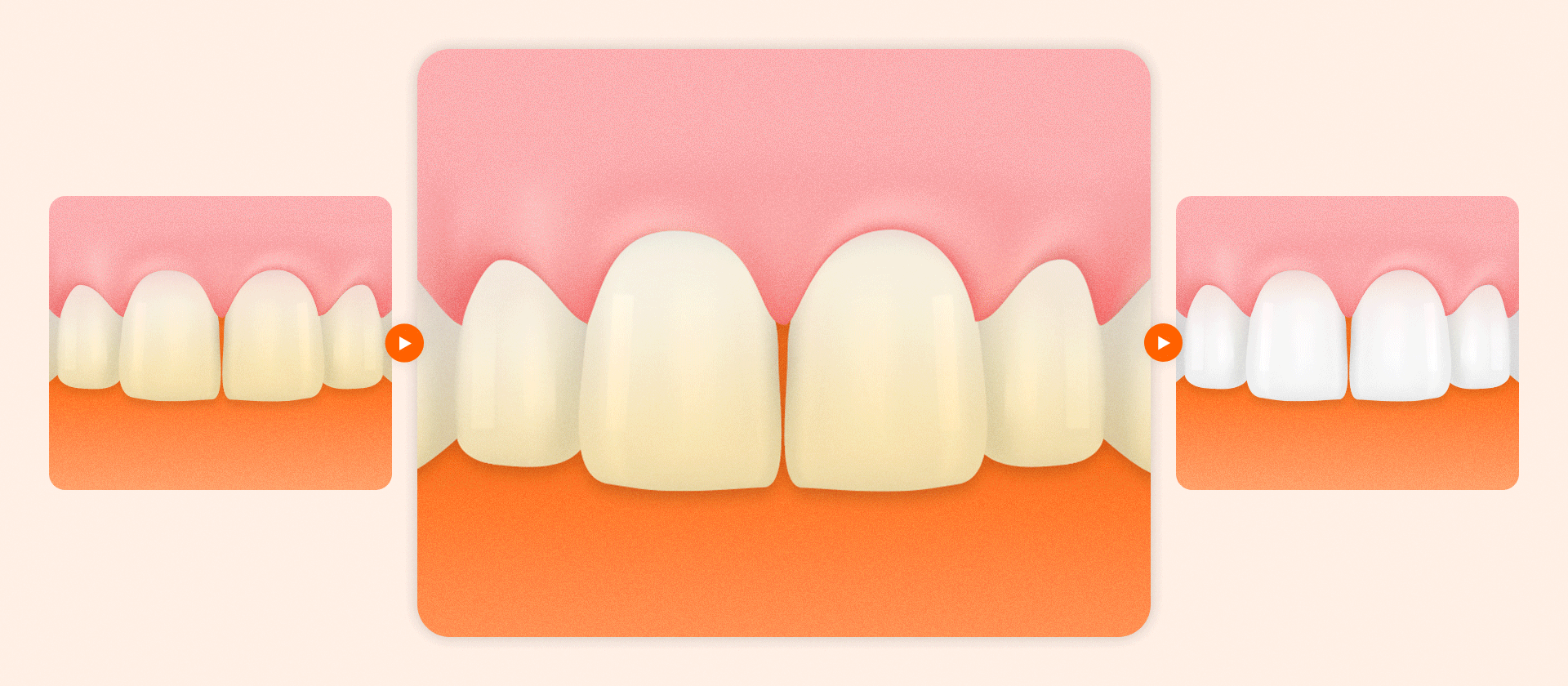 치아 미백의 원리 시각화. 과산화수소가 변색된 치아 표면에 작용하여 색소를 분해하고 치아를 하얗게 만드는 과정