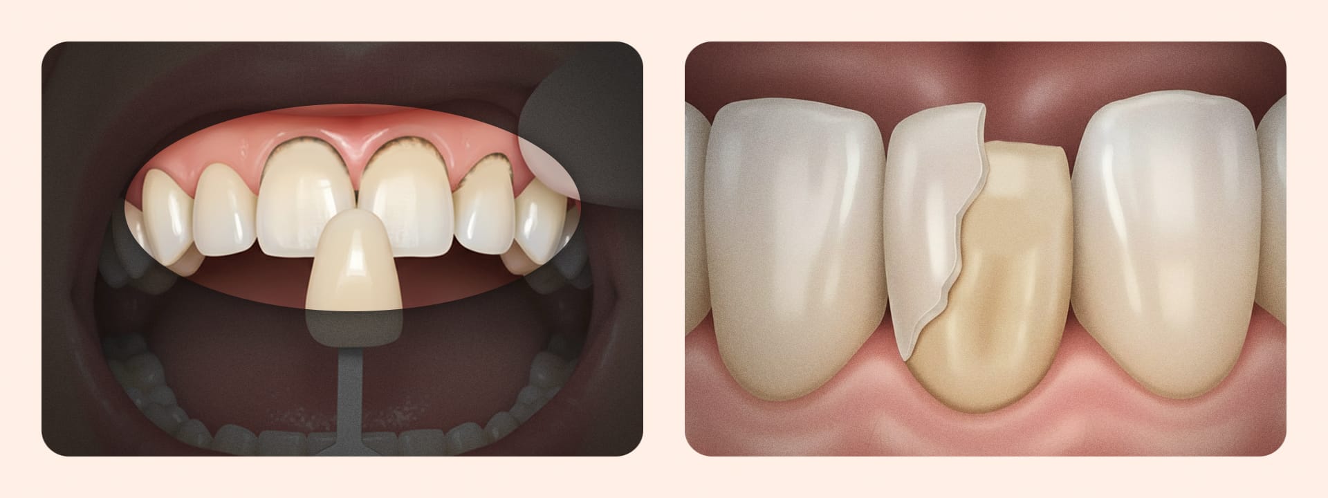 라미네이트와 자연 치아의 접착 경계면에 충치가 생기거나 라미네이트 팁이 파절된 모습을 보여주는 손상 예시 이미지