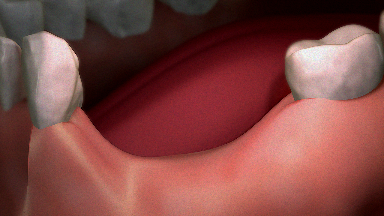 임플란트 틀니 | 헐거운 틀니 해결법과 비용