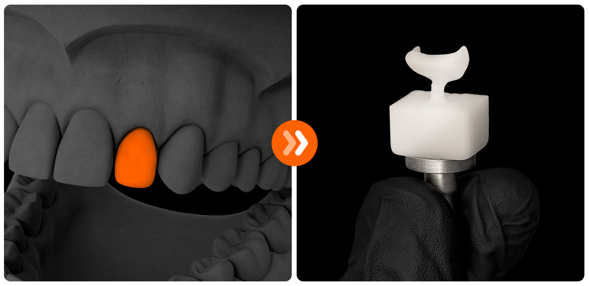 CAD(3D 스캔 데이터 확인)와 CAM(정밀 제작) 장비를 활용하여 라미네이트 보철물을 디지털로 설계하고 제작하는 과정을 보여주는 이미지