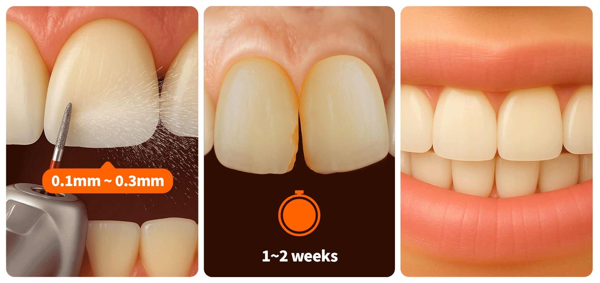 라미네이트의 장점 3가지(최소 삭제량, 빠른 효과, 오래가는 심미성)를 0.1mm~0.3mm 수치, 시계, 빛나는 치아 등의 디자인 요소로 표현한 이미지