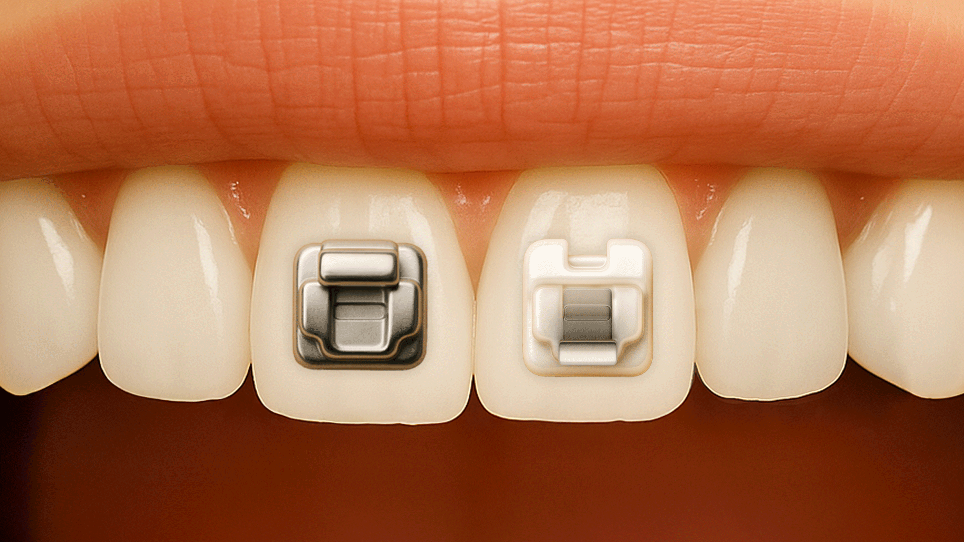 일반 브라켓은 고무링으로, 자가결찰 브라켓은 내장 클립으로 와이어를 고정하여 마찰력이 줄어드는 과정을 GIF로 보여주는 치아 클로즈업 이미지
