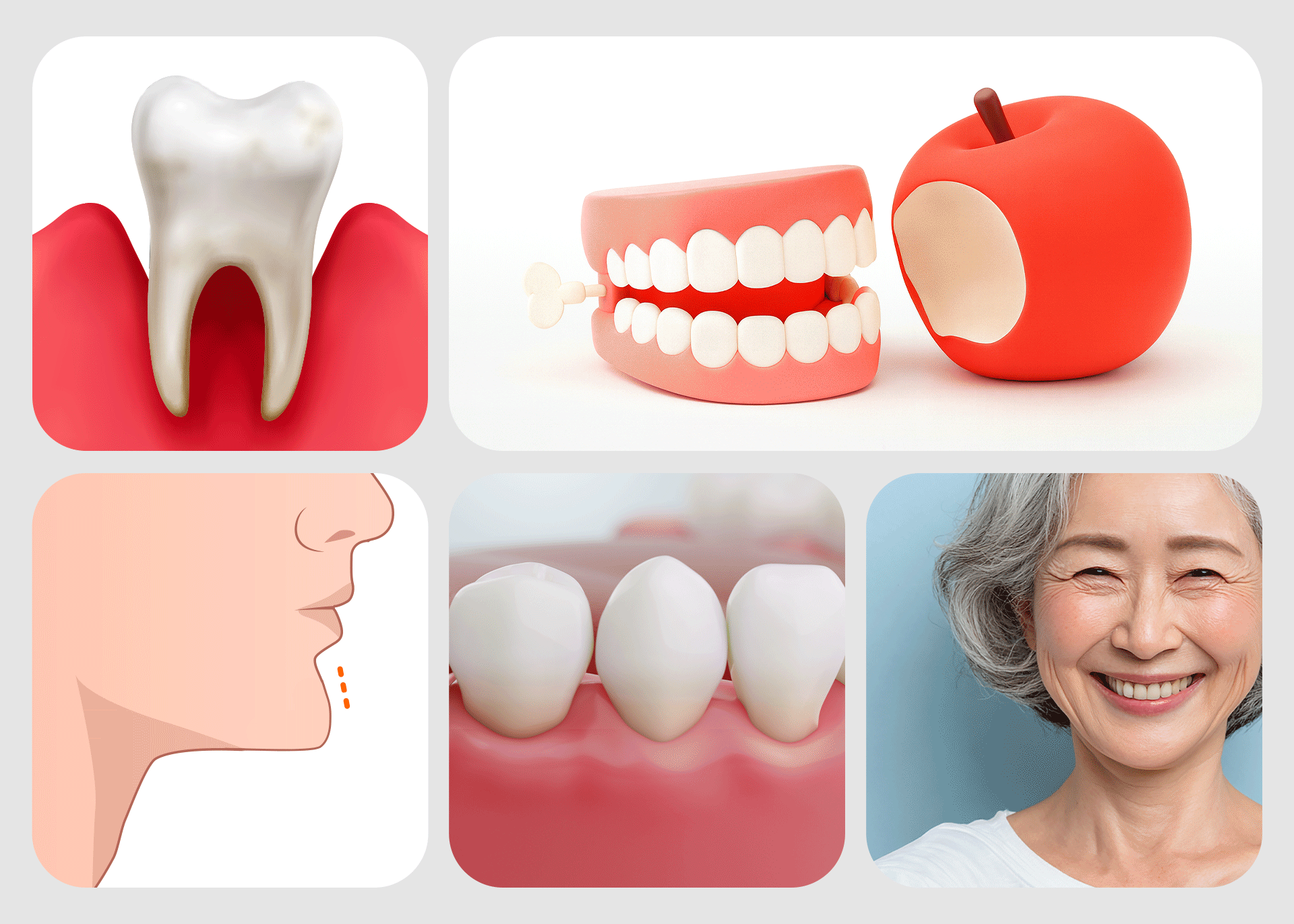 전악 임플란트 개수를 결정하는 핵심 요인(뼈 상태·저작력·턱뼈 구조·구강 건강·치료 계획)을 오브제로 시각화한 인포그래픽