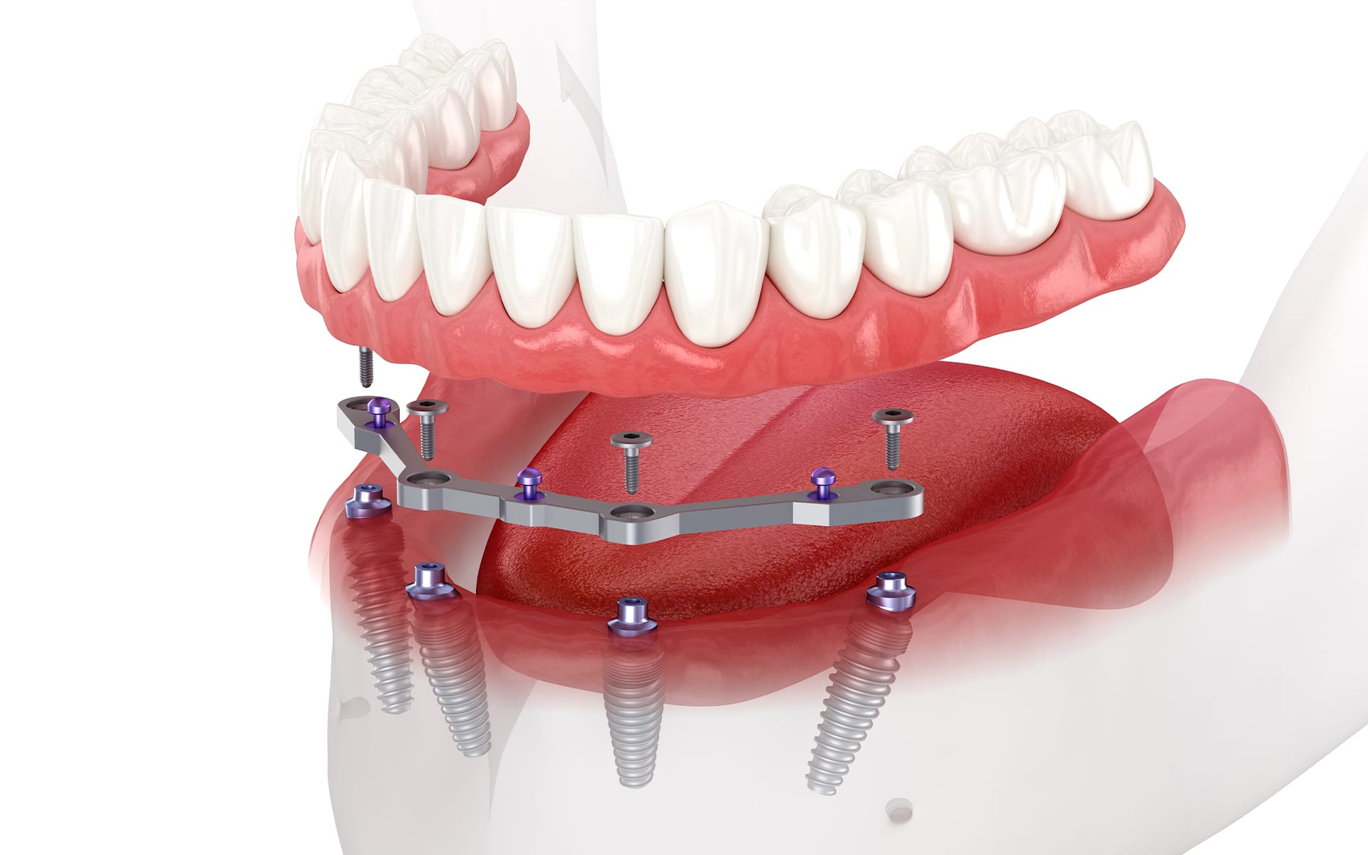 디지털 풀아치 임플란트가 적합한 경우를 설명하는 전악 임플란트 안내 이미지