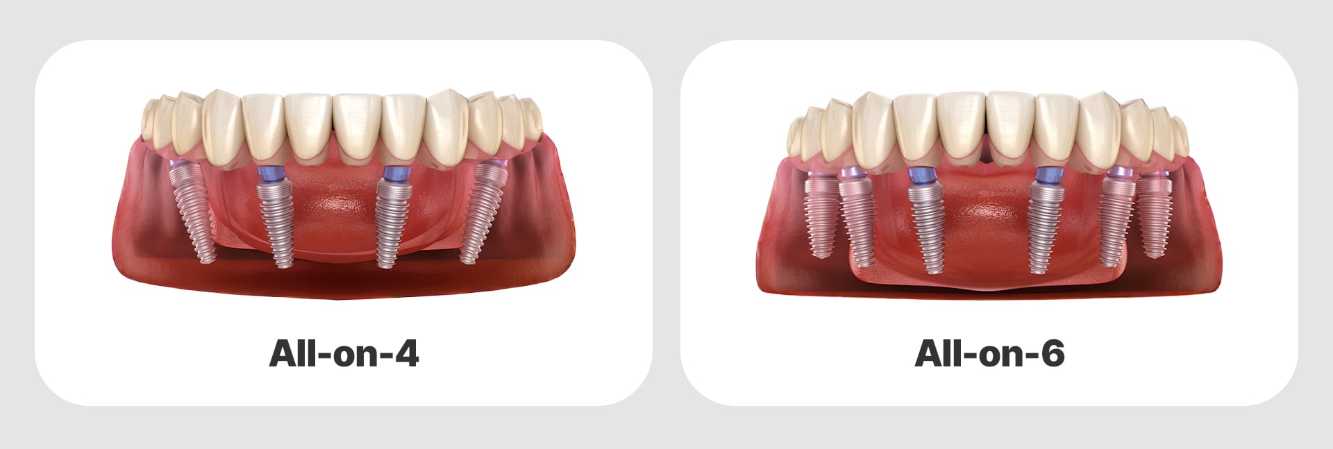 올온포(All-on-4)와 올온식스(All-on-6)의 식립 위치와 각도를 비교한 전악 임플란트 의학 일러스트