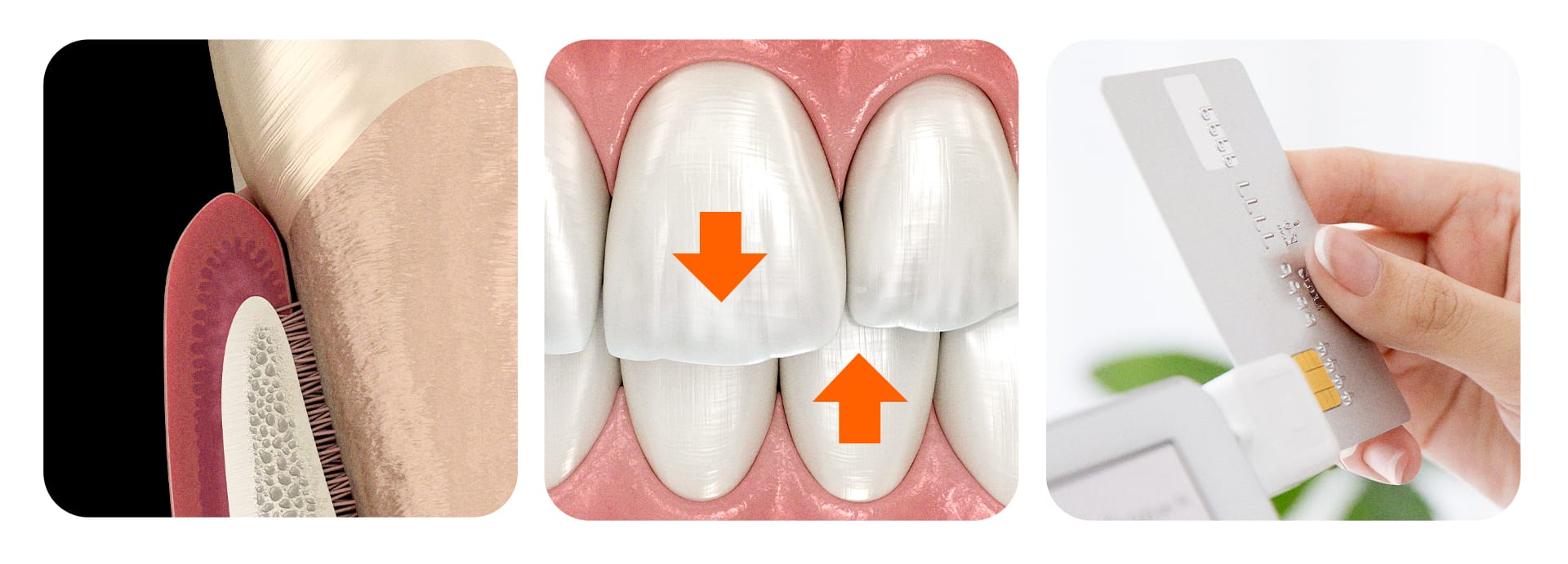 임플란트 식립 수를 결정하는 3가지 핵심 요소