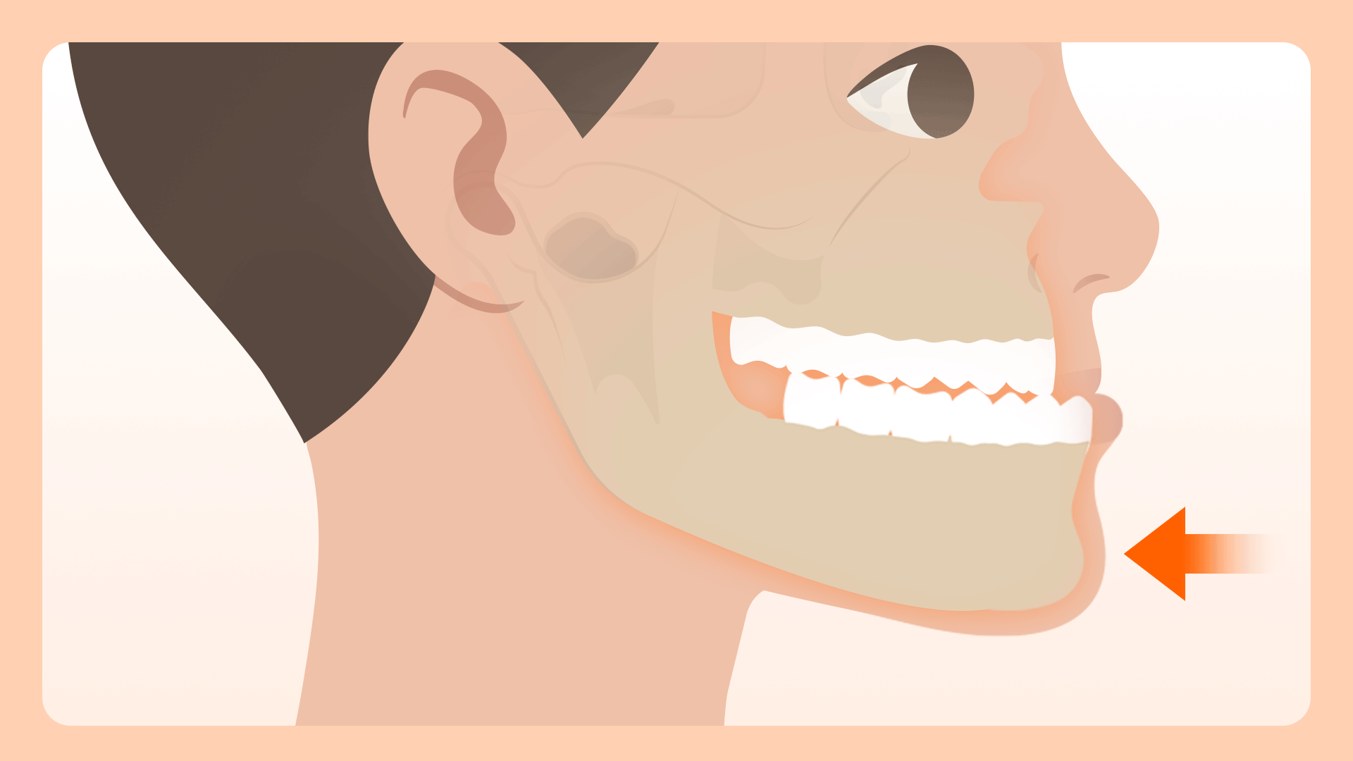 교정 전문의는 턱뼈 이동과 같은 고난도 증례를 해결할 수 있음을 보여주기 위해, 교정력을 통해 턱뼈의 위치를 변화시키는 장면을 표현한 의학 일러스트