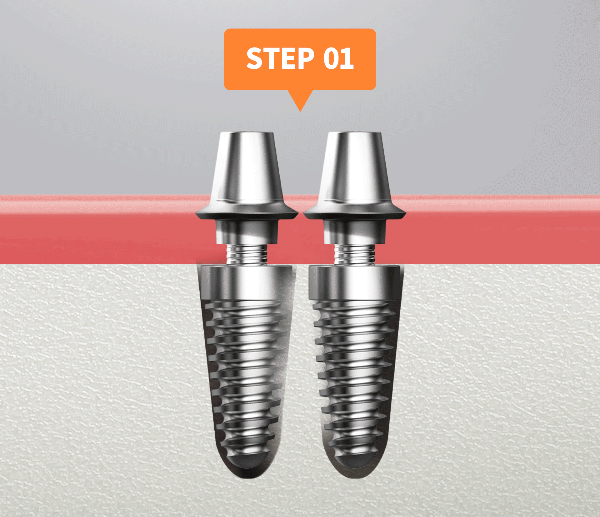 임플란트 복수 식립 시 임플란트 간 거리 3mm 이상을 표시한 일러스트 