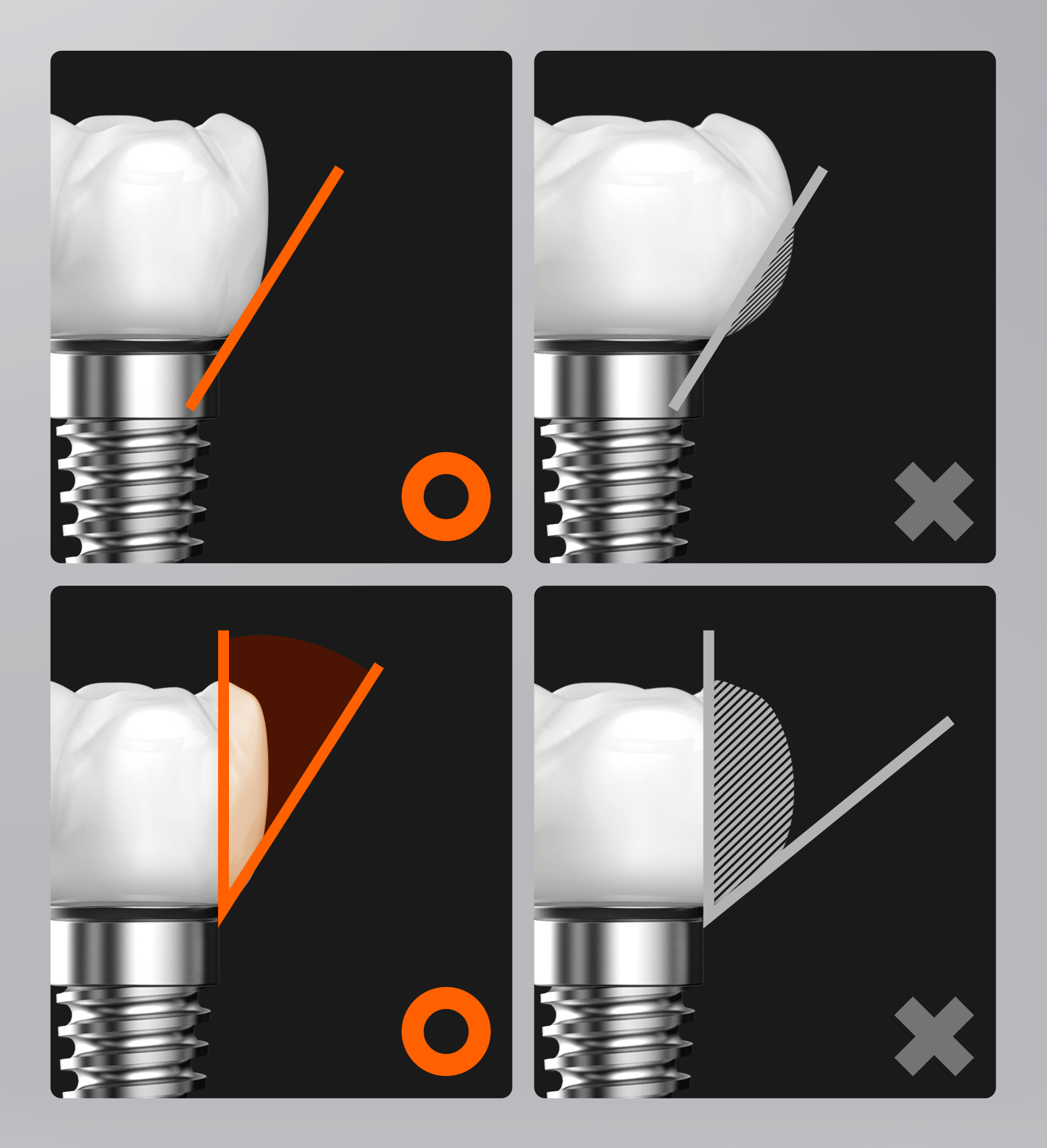 부적절한 보철물의 식립 형태 예시 
