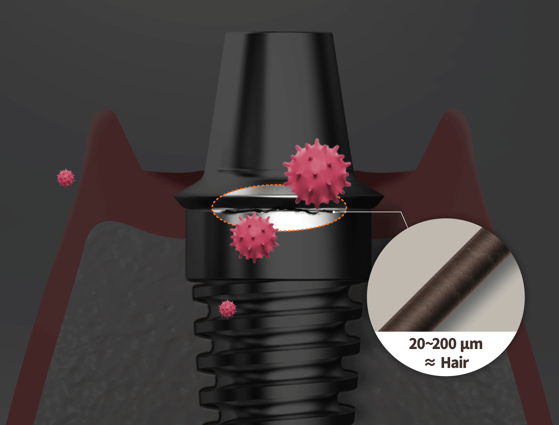 지대주 사이 머리카락 한 올 정도 미세틈새(20~200㎛ microgap)를 보여주는 일러스트 