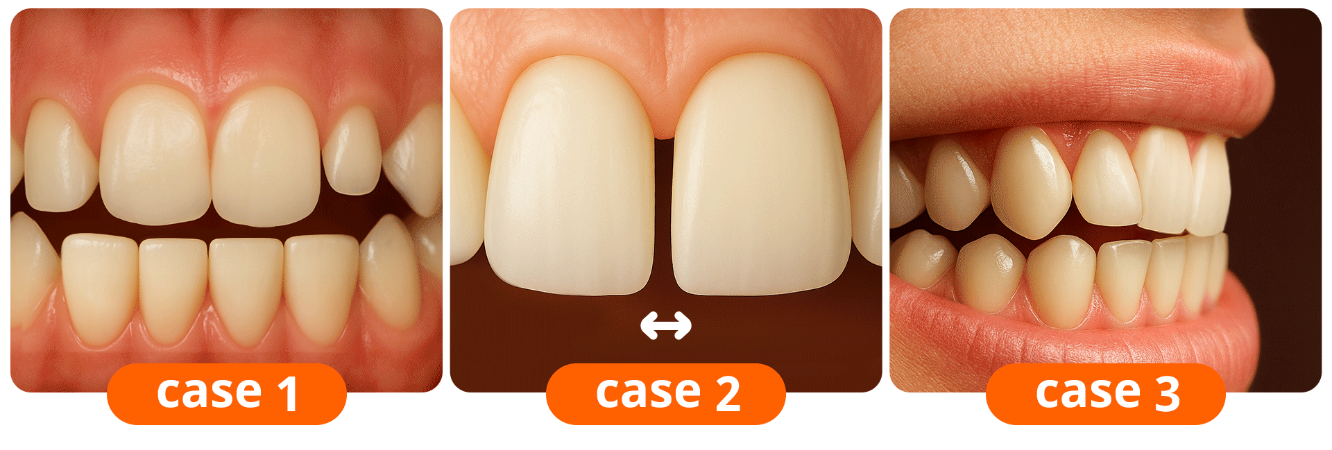 An infographic illustrating the 3 recommended cases for no-prep laminates: microdontia (small teeth), gaps between teeth, and lingually inclined teeth