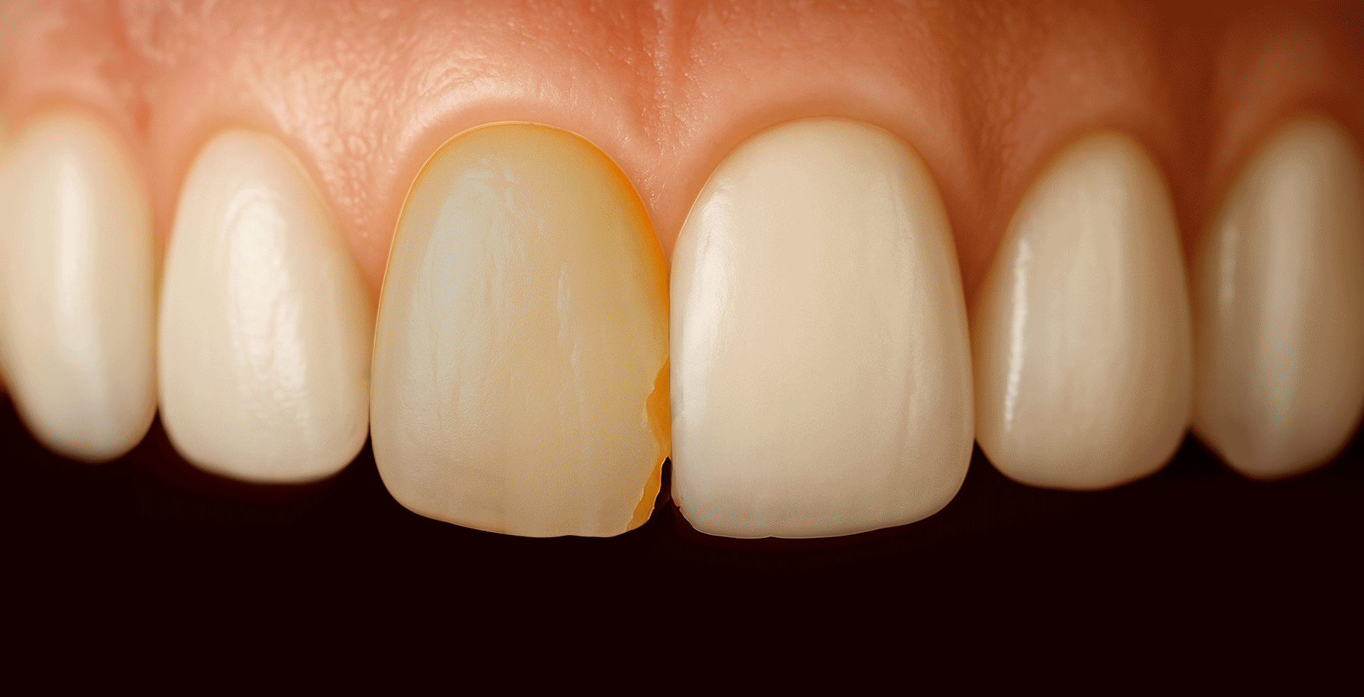 An image showing the procedural steps of front tooth restoration by slightly reducing the tooth surface and bonding a thin ceramic veneer (laminate)