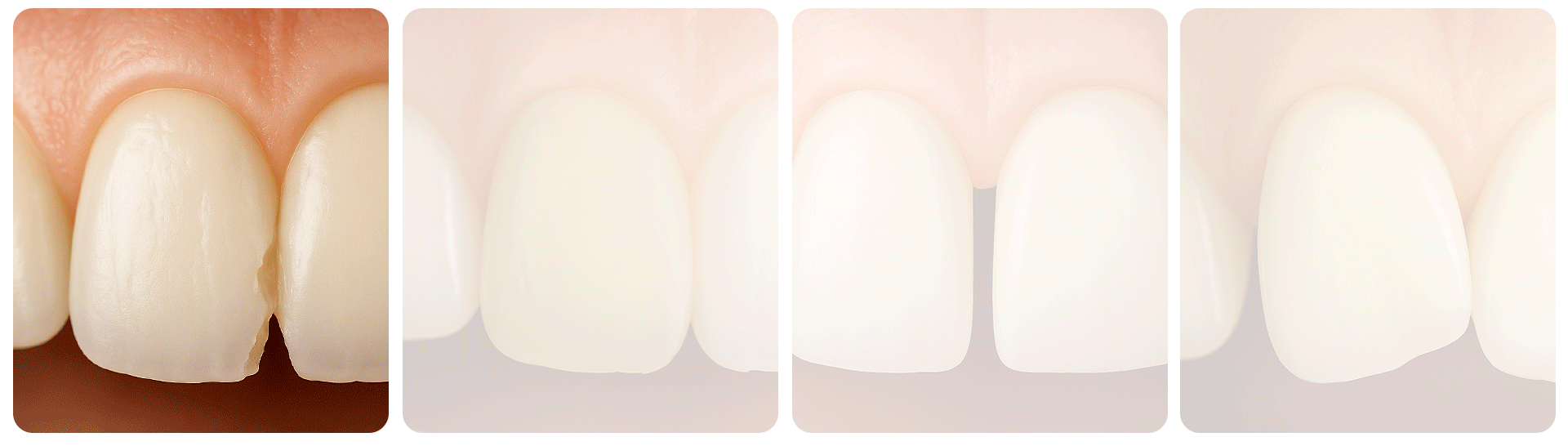 An infographic visualizing the 4 main scenarios requiring front tooth laminates: chipped tooth, discoloration, gaps between teeth, and minor misalignment