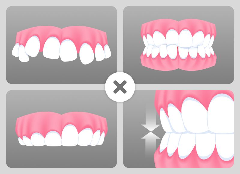Illustration of complex oral structures, such as severe crowding or unstable bites, that require multi-day veneer treatment.
