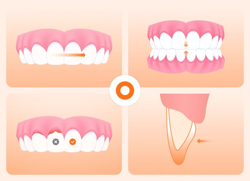 Illustration of ideal dental alignment and healthy gums suitable for same-day veneer procedures.