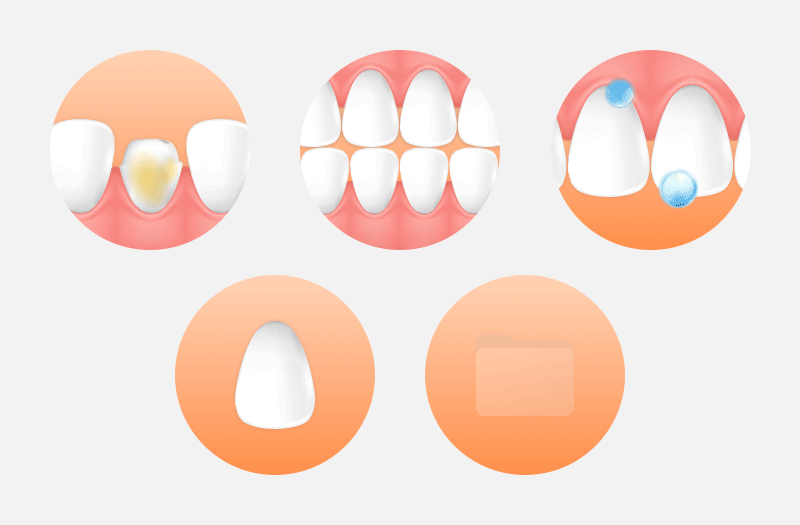 A checklist infographic highlighting 5 essential criteria to check before looking at the price tag for veneers.