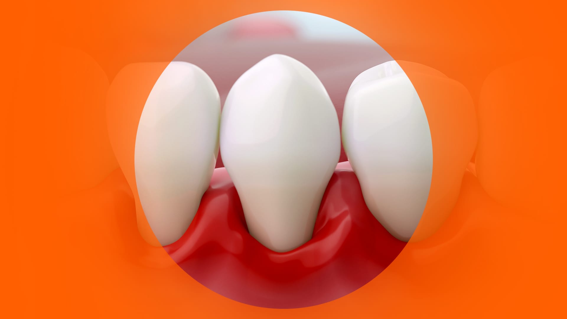 インプラント周囲炎の始まり ― この症状、見過ごさないでください