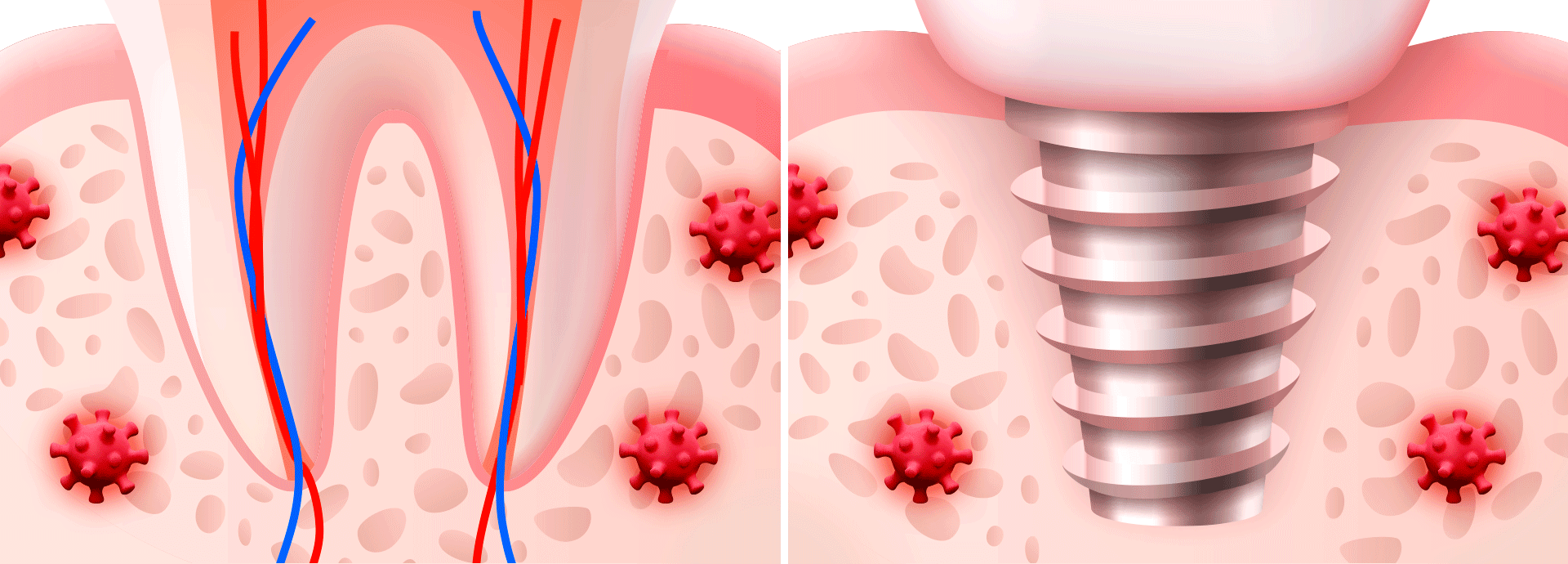 자연치아 VS 임플란트 구조적 차이