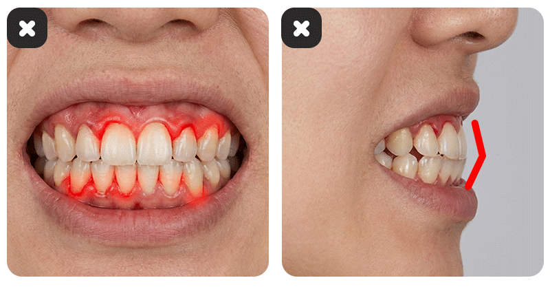 Illustration showing contraindications for veneers, such as inflamed gums and unstable bite (malocclusion).
