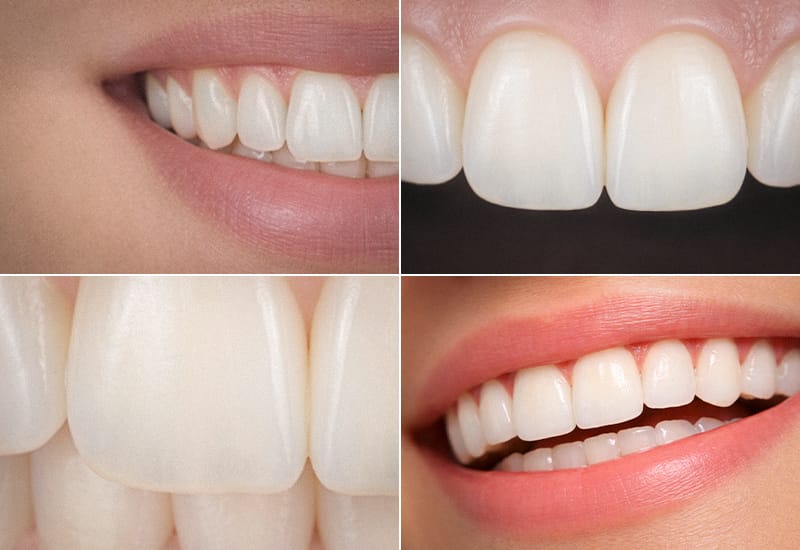 An image illustrating the 4 key elements of natural smile design: Color, Shape, Translucency, and Harmony.