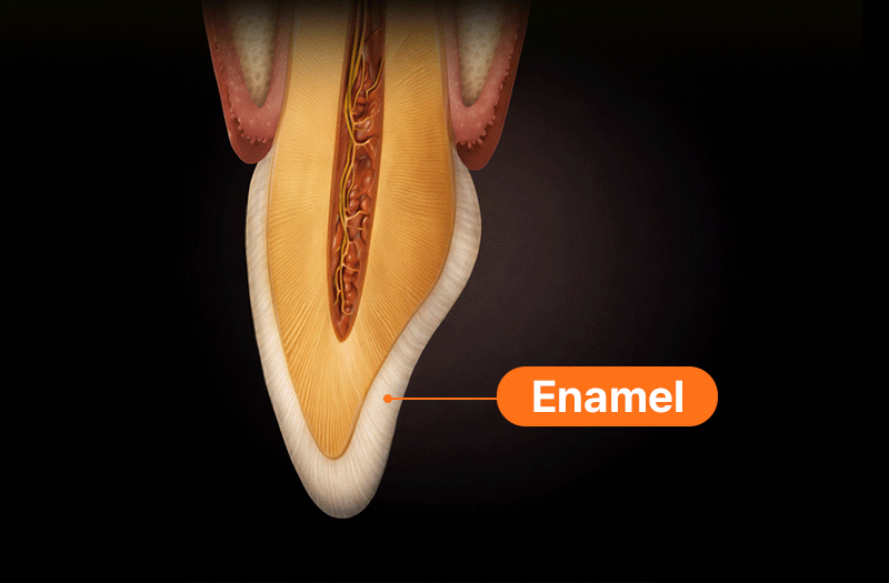 An image showing a laminate veneer bonded to the tooth enamel.