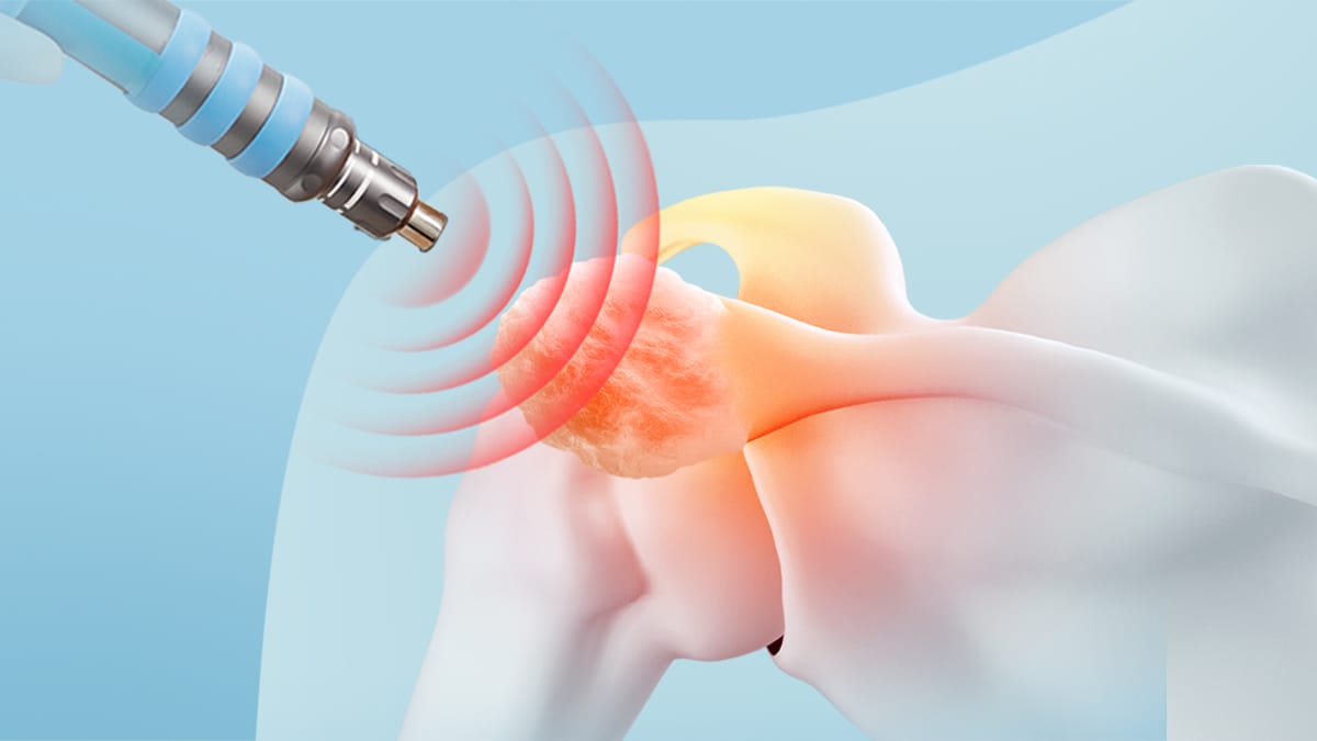 만성 어깨통증, 비수술로 치료할 수 있습니다