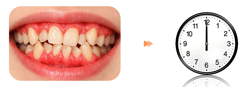 An image representing rapid orthodontic treatment and accelerated tooth movement.