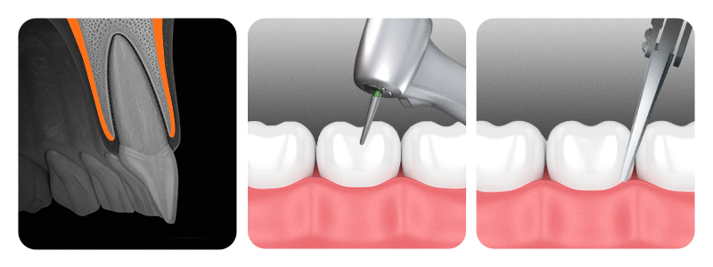 A visual depiction of the three core ancillary therapies used in rapid orthodontics to enhance biological response.