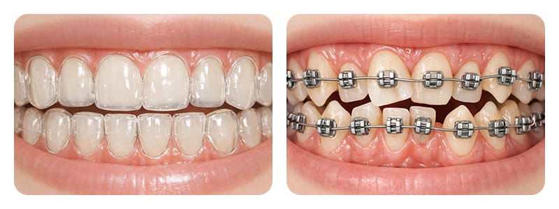 Image intuitively comparing the physical shapes and materials of metal brackets and clear aligners.