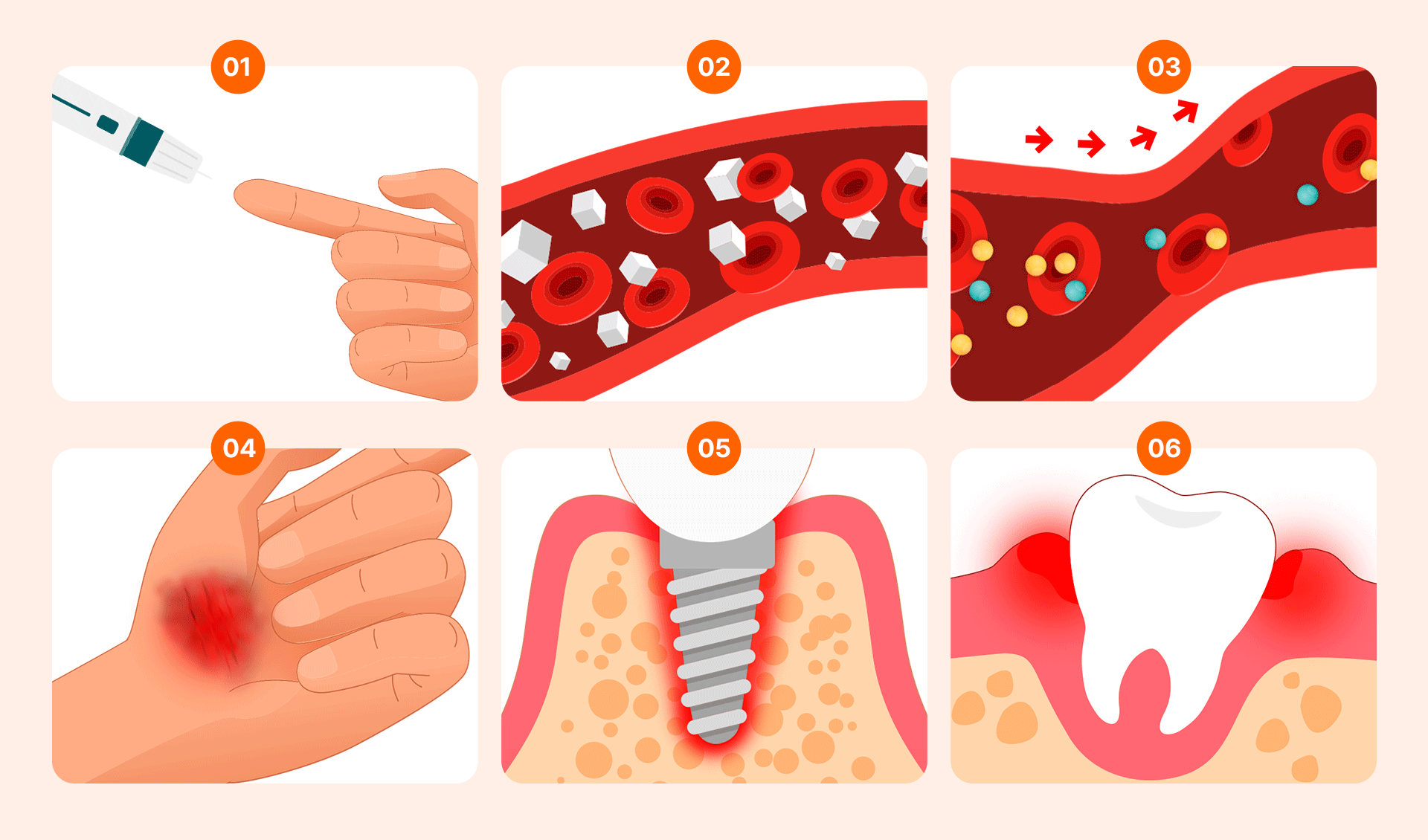 An image sequentially illustrating the relationship between diabetes and dental implants over time