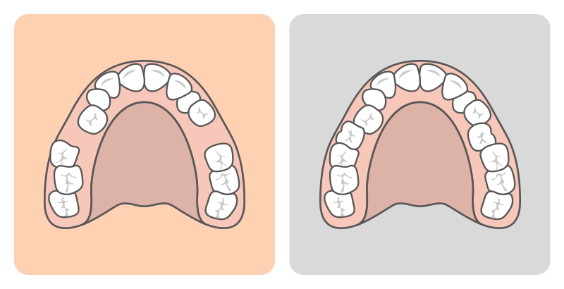 Changes in tooth movement in extraction versus non-extraction cases.