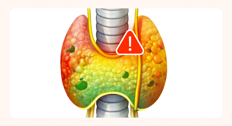 Diagram indicating danger zones based on the location of nodules within the thyroid.