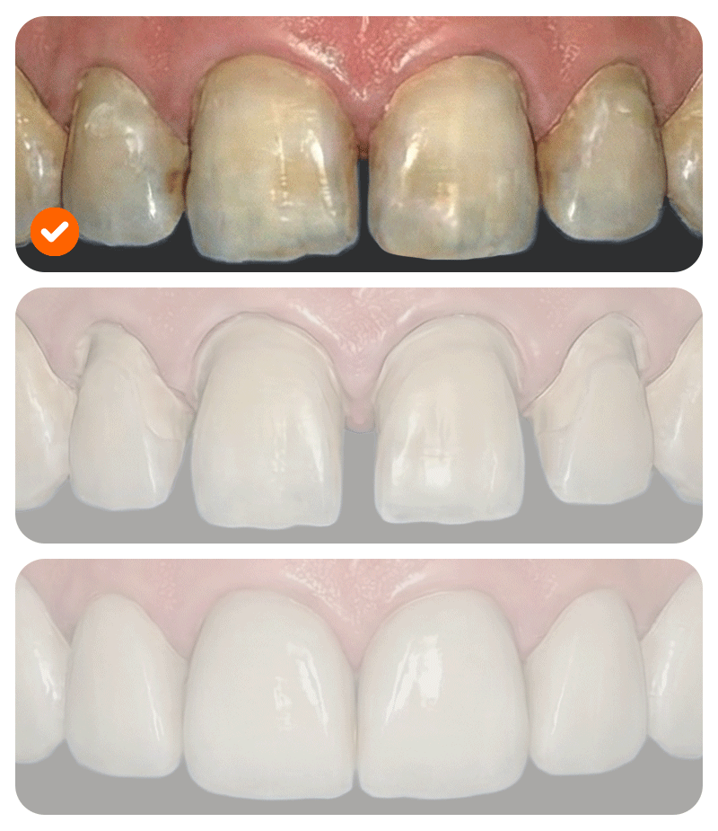 Essential 3D intraoral scan data for international patients getting dental veneers in Korea.